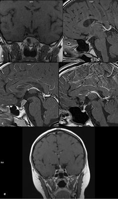 Pituitary Stalk Thickening: Causes and Consequences. The Children’s Memorial Health Institute Experience and Literature Review